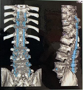 CT脊椎画像
