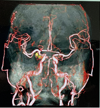 CT頭部血管