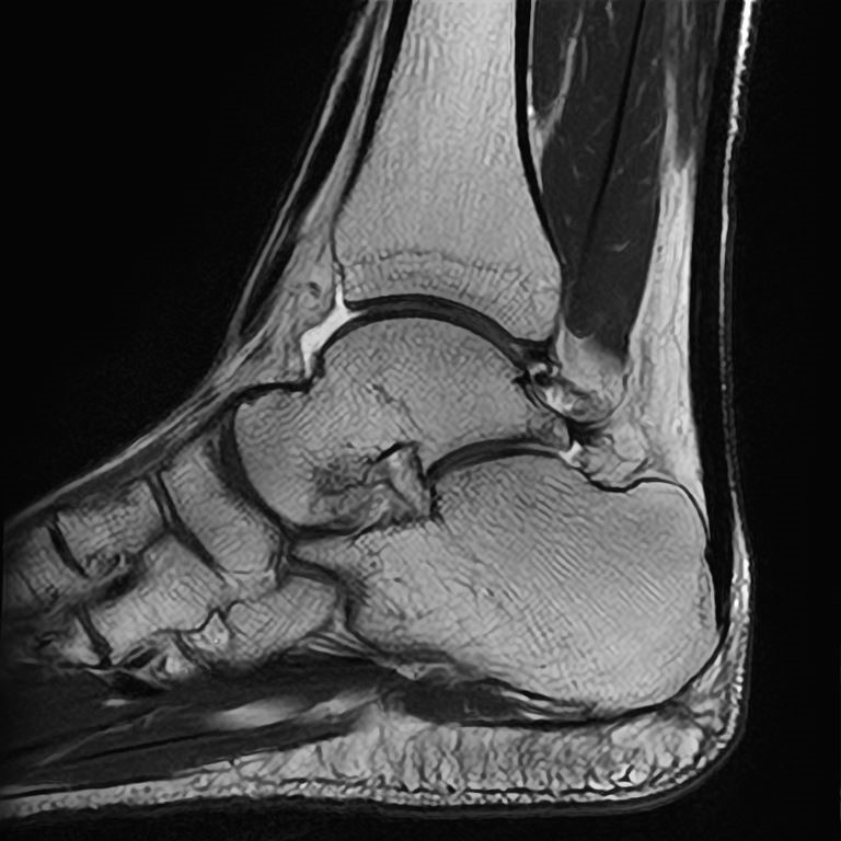 足関節MRI
