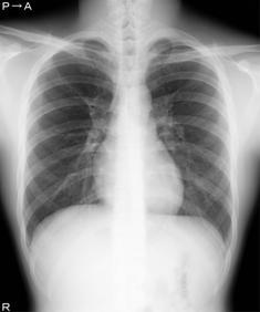 胸部のレントゲン写真
