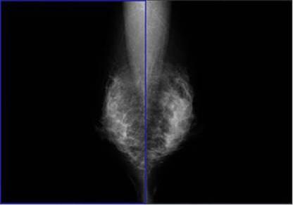 乳房（腺）のマンモグラフィ撮影写真
